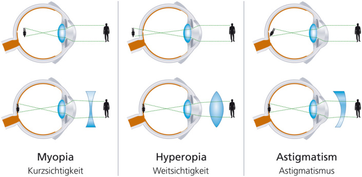 Sehfehler Augenmedizin At