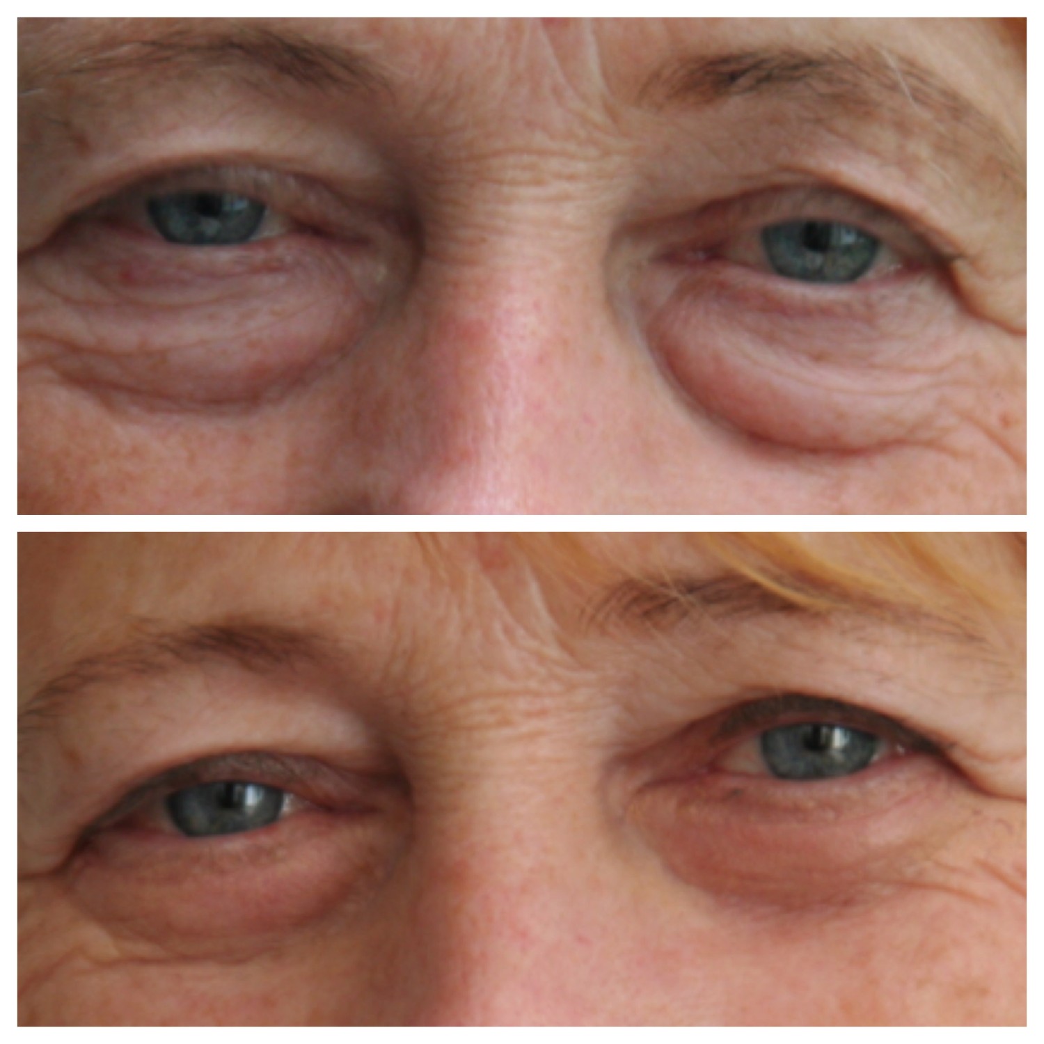 BLEPHAROPLASTIK UNTEN 1 Augenmedizin At